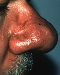 Subtype 3: Enlargement of the Nose (Phymatous Rosacea)