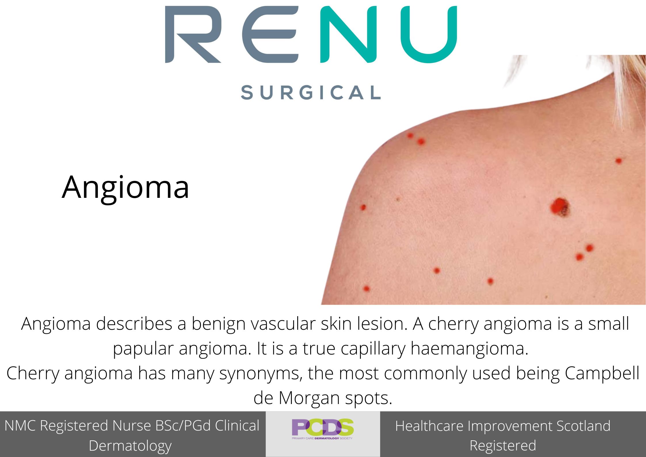 Cherry Angioma Renu Skin Clinic 