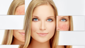 Rosacea and Redness