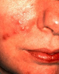 Subtype 2: Bumps and Pimples (Papulopustular Rosacea)