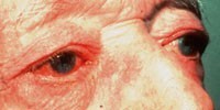 Subtype 4: Eye Irritation (Ocular Rosacea)