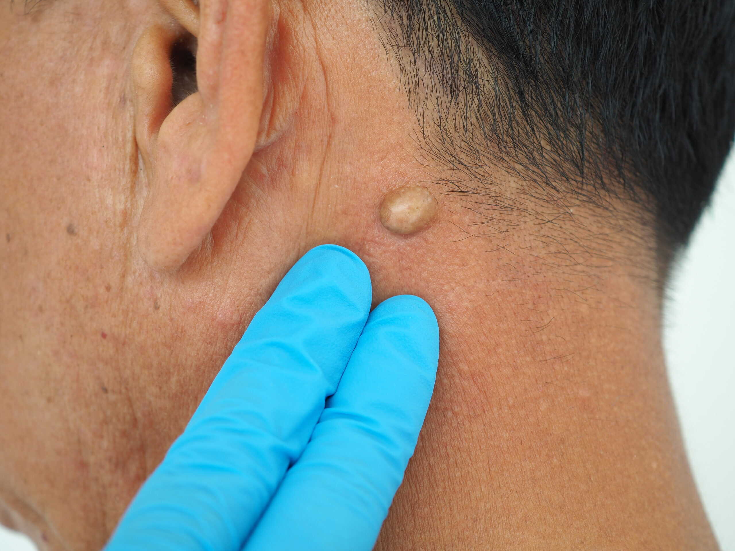 cyst removal dundee